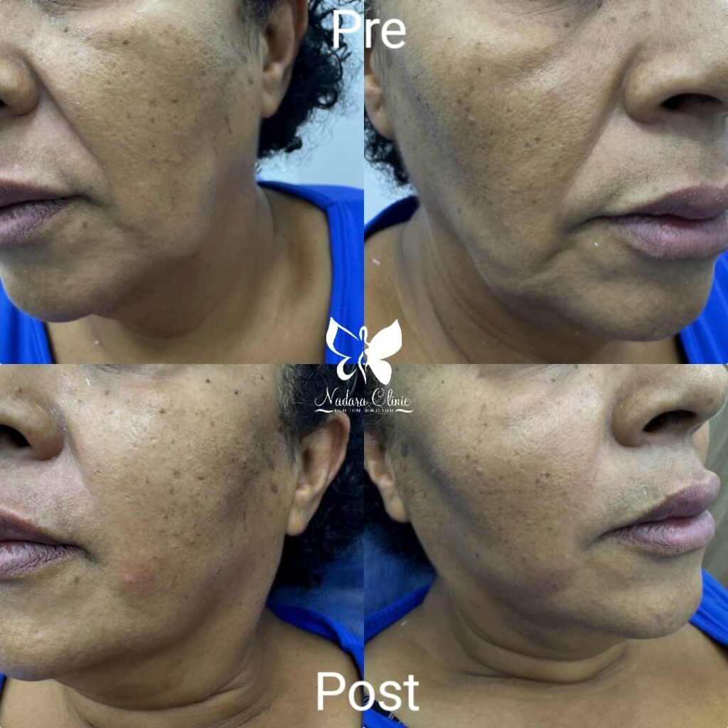 Lifting cheeks and smile lines with Olidia injections